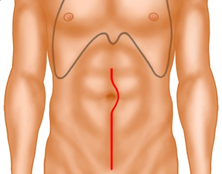 Laparotomie