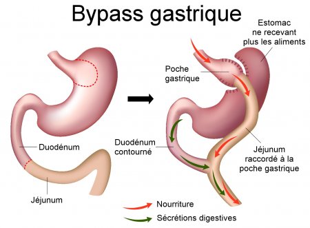 By pass gastrique